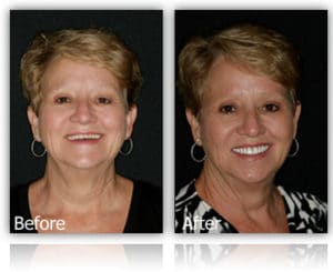 Facelift Dentures Before and Afters